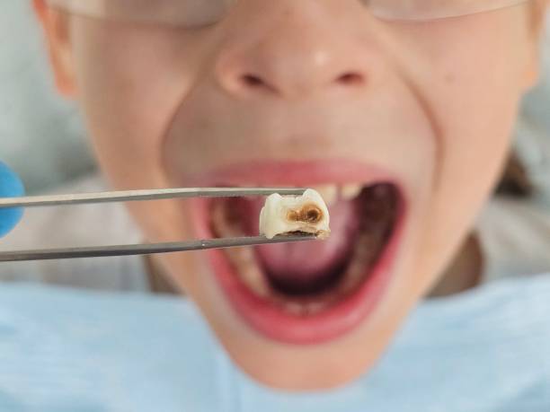 Best Emergency Dentist for Lost Fillings or Crowns in Lucedale, MS